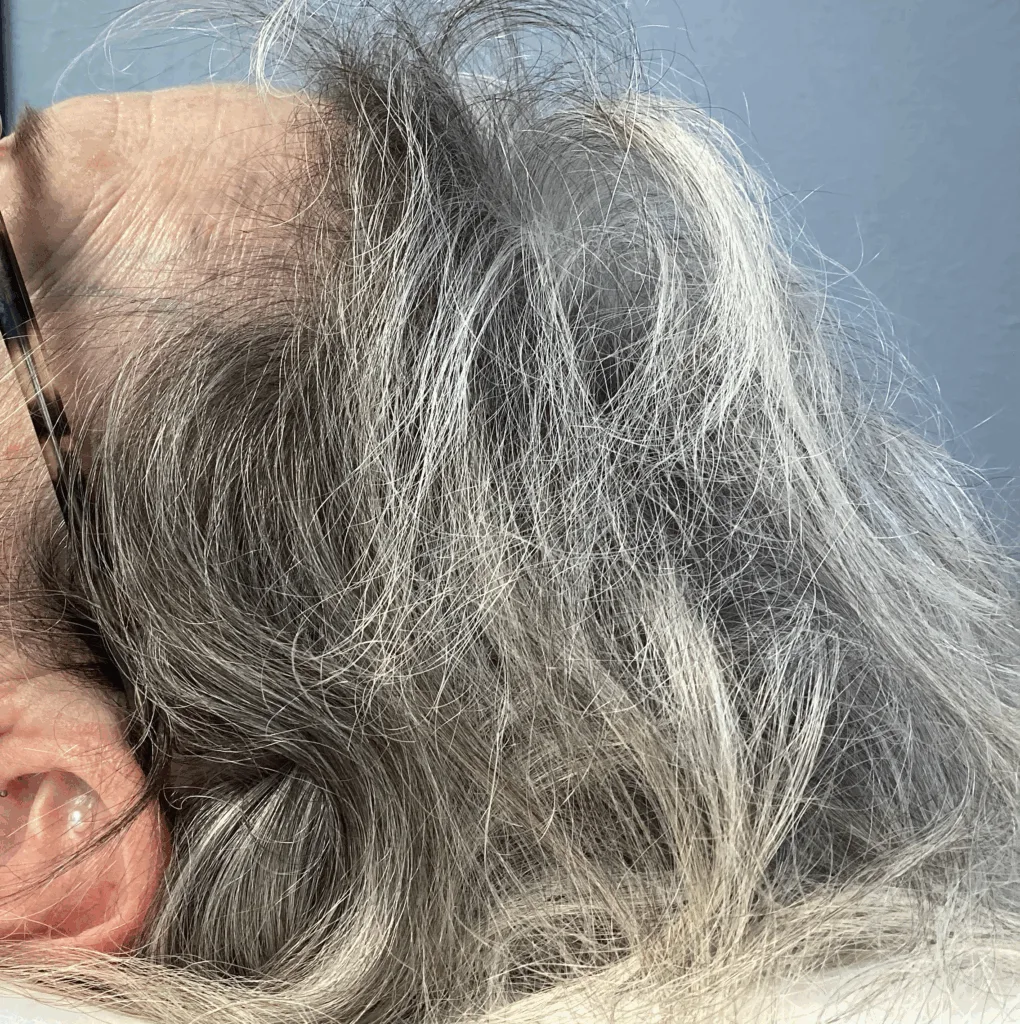 Image showing after microneedle treatment