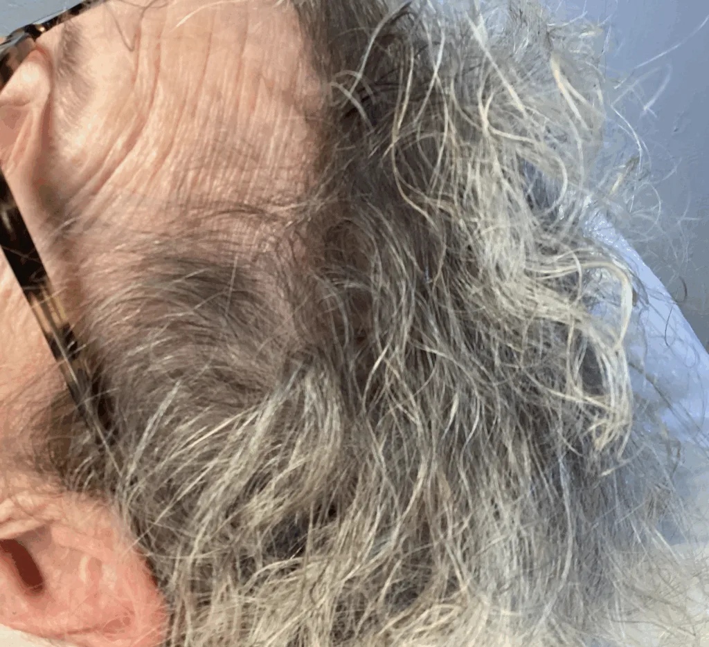 image showing before microneedle treatment
