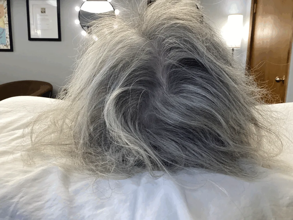 image showing after microneedle treatment