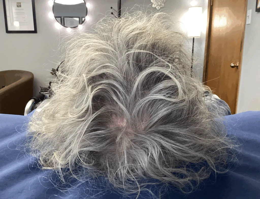 image showing before microneedle treatment